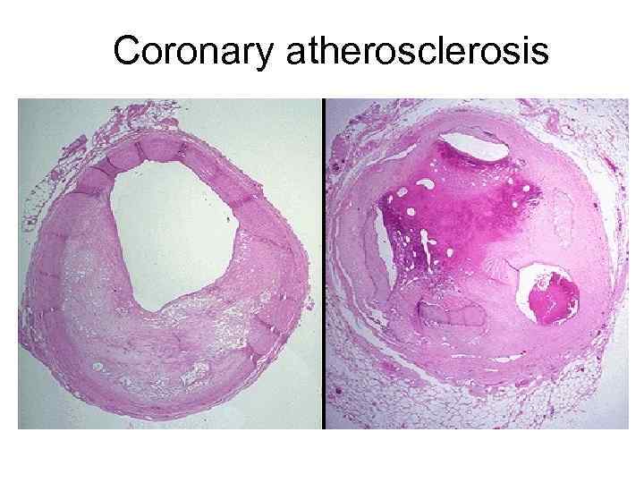 Coronary atherosclerosis 