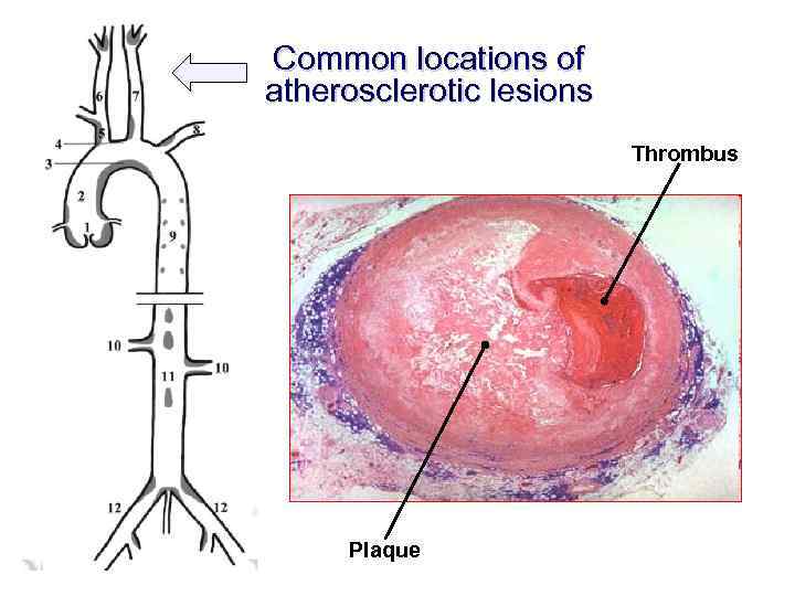 Common locations of atherosclerotic lesions Thrombus Plaque 