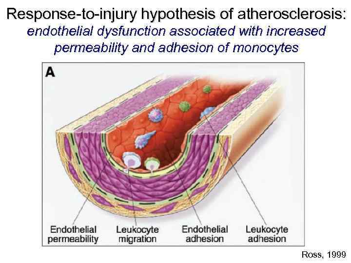 Response-to-injury hypothesis of atherosclerosis: endothelial dysfunction associated with increased permeability and adhesion of monocytes