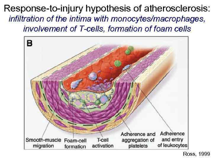 Response-to-injury hypothesis of atherosclerosis: infiltration of the intima with monocytes/macrophages, involvement of T-cells, formation