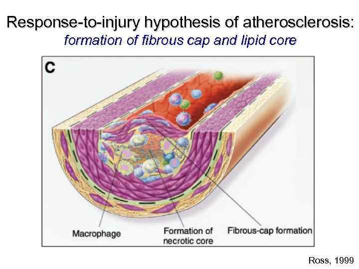 Response-to-injury hypothesis of atherosclerosis: formation of fibrous cap and lipid core Ross, 1999 