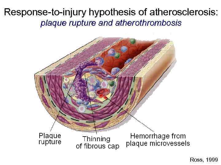 Response-to-injury hypothesis of atherosclerosis: plaque rupture and atherothrombosis Ross, 1999 