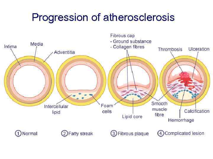 Progression of atherosclerosis 