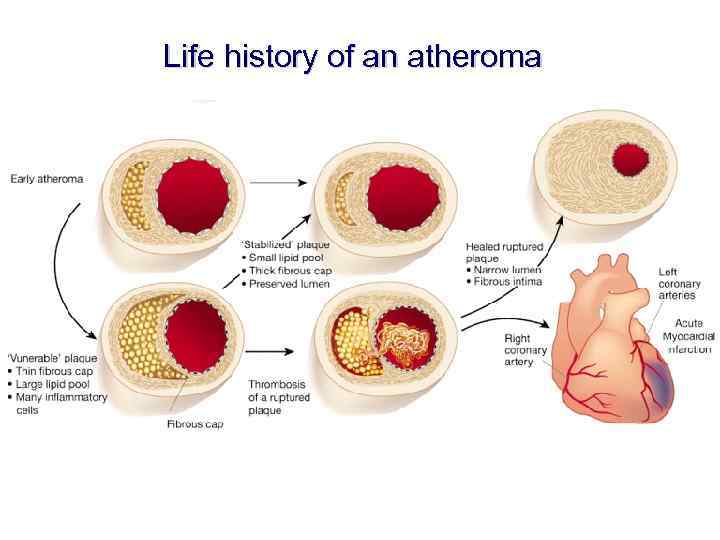 Life history of an atheroma 