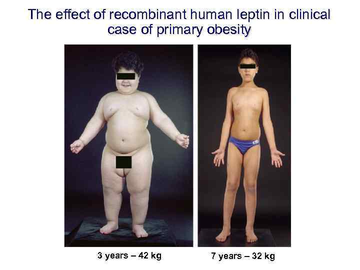 The effect of recombinant human leptin in clinical case of primary obesity 3 years