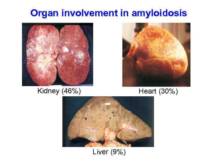 Organ involvement in amyloidosis Kidney (46%) Heart (30%) Liver (9%) 