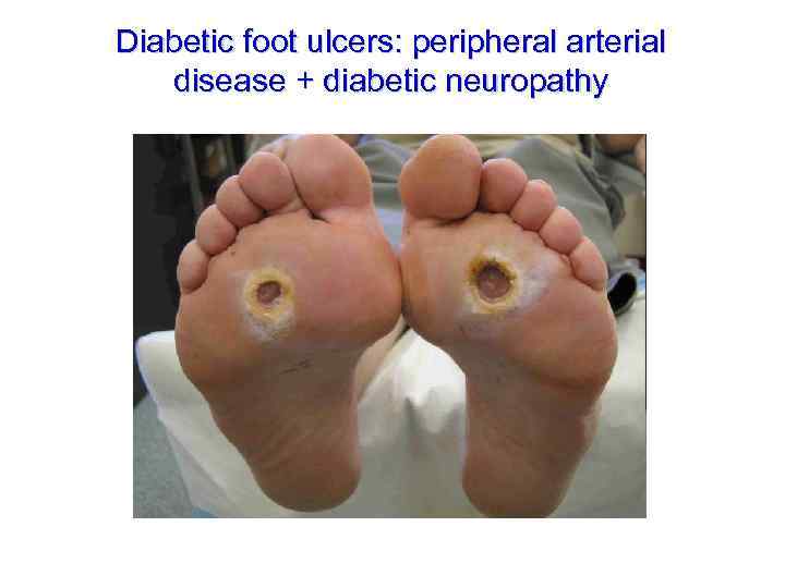 Diabetic foot ulcers: peripheral arterial disease + diabetic neuropathy 