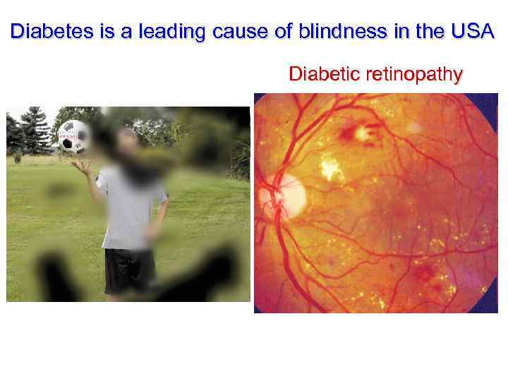Diabetes is a leading cause of blindness in the USA Diabetic retinopathy 