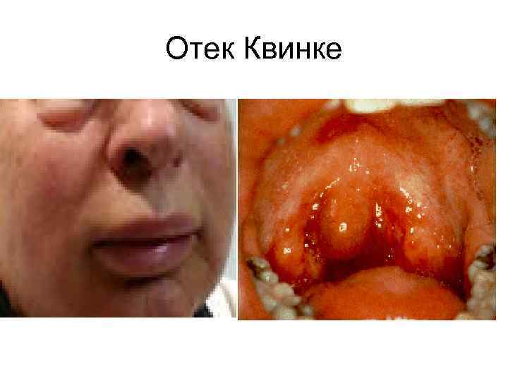 Отек Квинке 