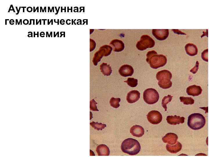 Аутоиммунная гемолитическая анемия 