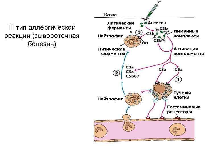 Кожа III тип аллергической реакции (сывороточная болезнь) Литические ферменты Антиген Нейтрофил Иммунные комплексы Литические