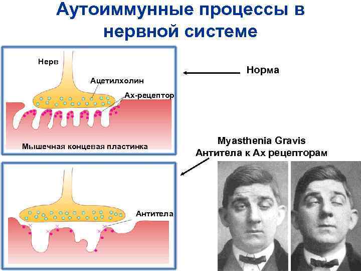 Аутоиммунные процессы в нервной системе Нерв Норма Ацетилхолин Ах-рецептор Мышечная концевая пластинка Антитела Myasthenia
