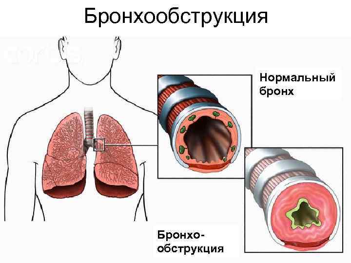 Бронхообструкция Нормальный бронх Бронхообструкция 