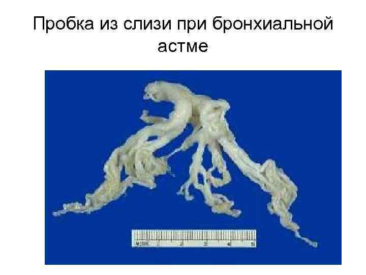 Пробка из слизи при бронхиальной астме 