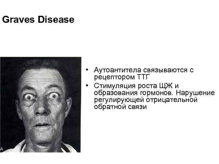Graves Disease • Аутоантитела связываются с рецептором ТТГ • Стимуляция роста ЩЖ и образования