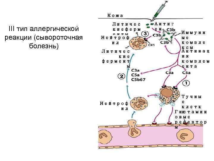 Кожа III тип аллергической реакции (сывороточная болезнь) Литичес киеферм енты Нейтроф ил Литичес кие