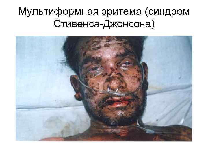 Мультиформная эритема (синдром Стивенса-Джонсона) 