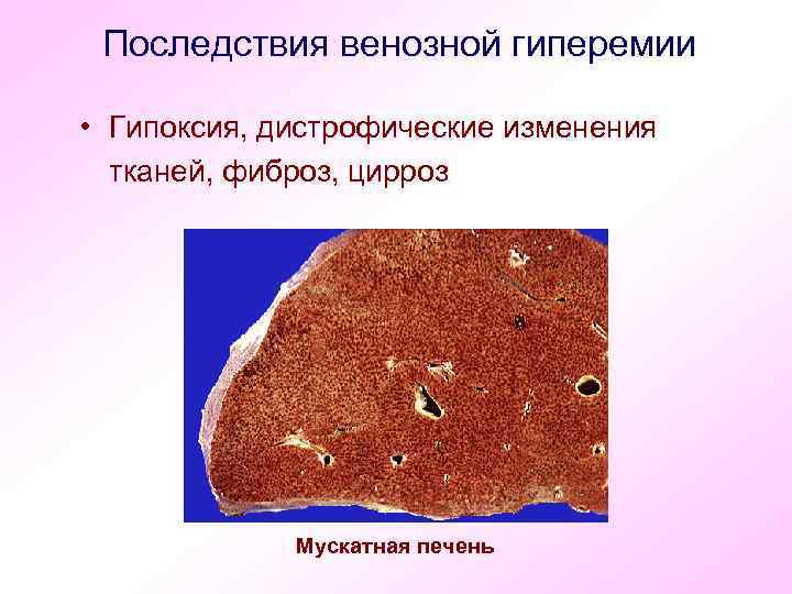 Признаки венозной гиперемии рисунок