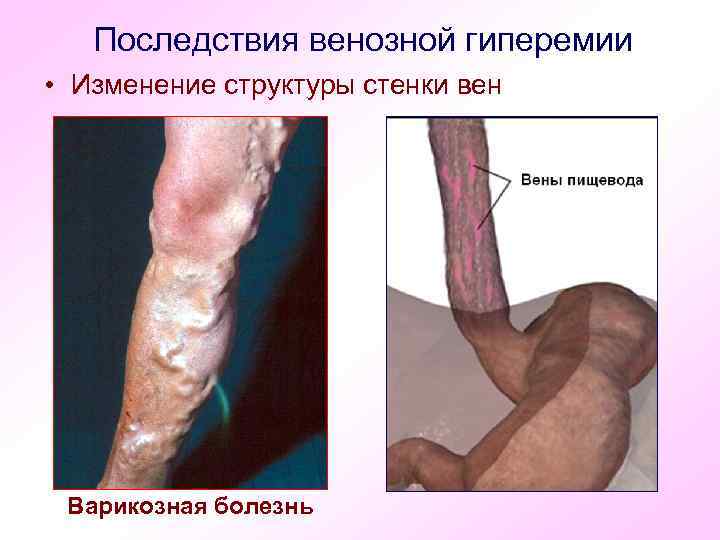 Последствия венозной гиперемии • Изменение структуры стенки вен Варикозная болезнь 