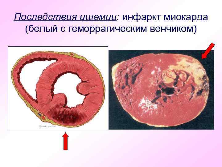 Последствия ишемии: инфаркт миокарда (белый с геморрагическим венчиком) 