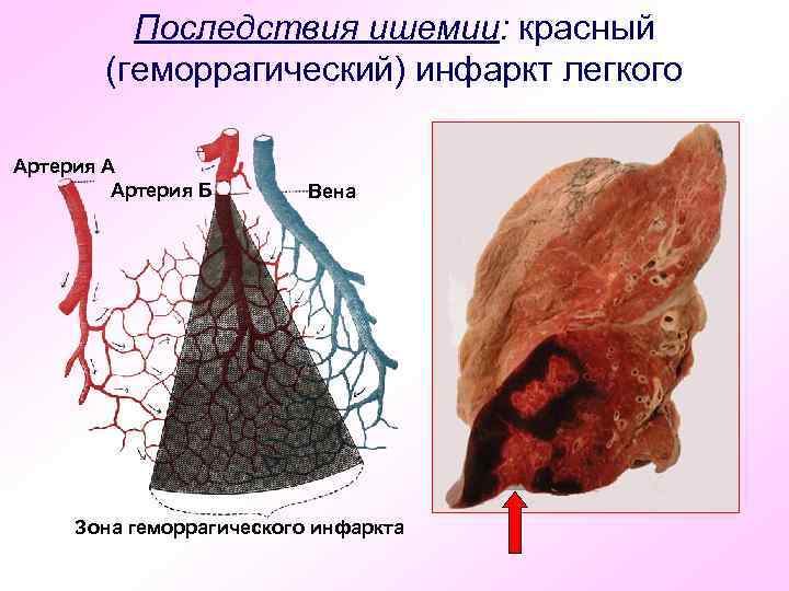 Последствия ишемии: красный (геморрагический) инфаркт легкого Артерия А Артерия Б Вена Зона геморрагического инфаркта