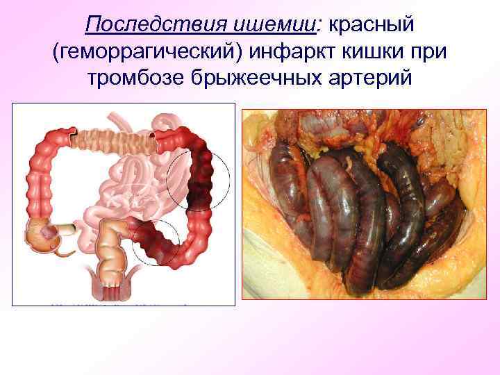 Последствия ишемии: красный (геморрагический) инфаркт кишки при тромбозе брыжеечных артерий 