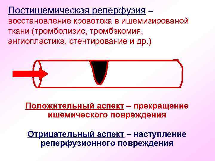 Постишемическая реперфузия – восстановление кровотока в ишемизированой ткани (тромболизис, тромбэкомия, ангиопластика, стентирование и др.