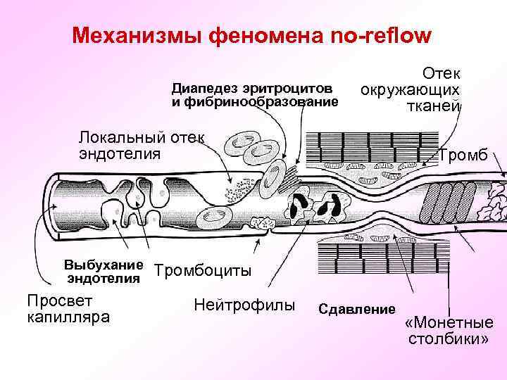 Механизмы феномена no-reflow Диапедез эритроцитов и фибринообразование Отек окружающих тканей Локальный отек эндотелия Выбухание