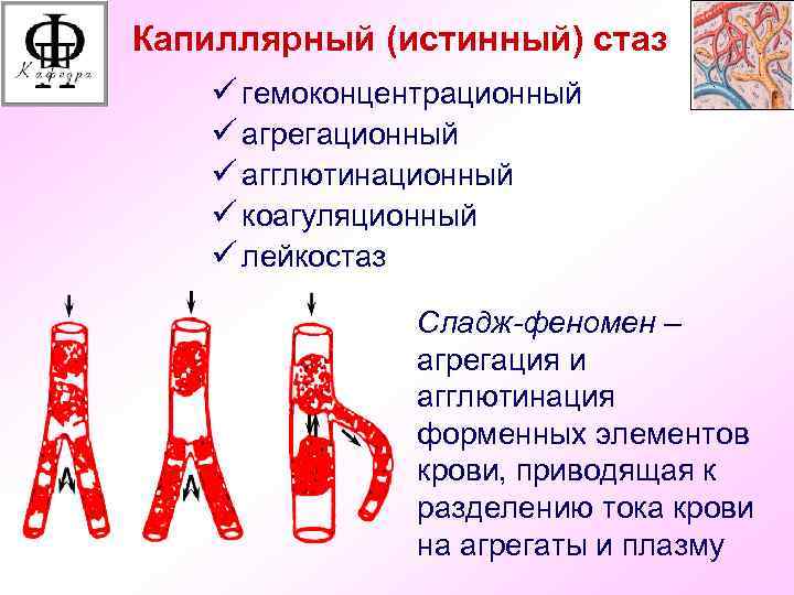 Капиллярный (истинный) стаз ü гемоконцентрационный ü агрегационный ü агглютинационный ü коагуляционный ü лейкостаз Сладж-феномен