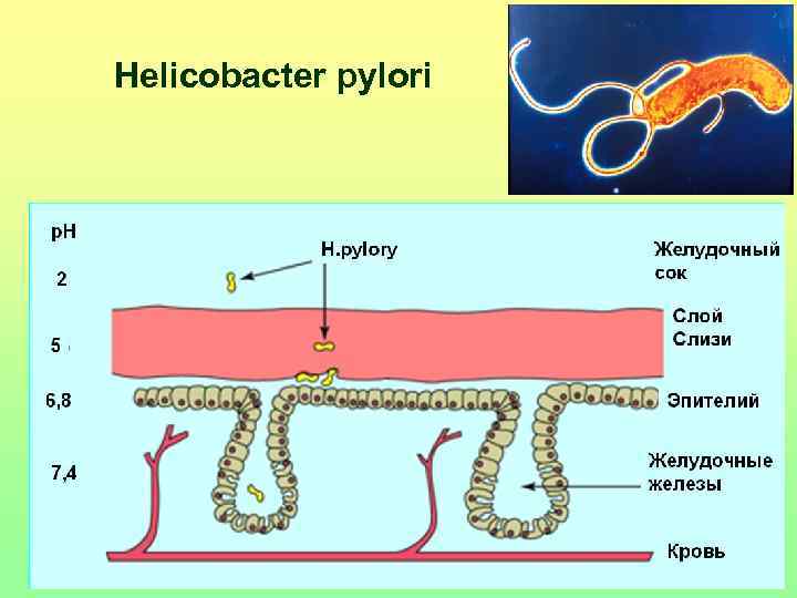 Helicobacter pylori 