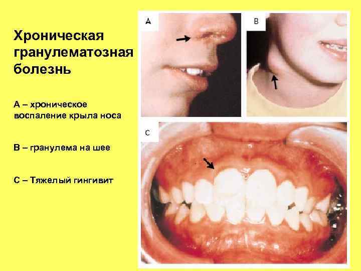 Хроническая гранулематозная болезнь А – хроническое воспаление крыла носа В – гранулема на шее