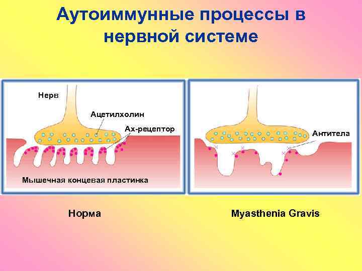 Аутоиммунные процессы в нервной системе Нерв Ацетилхолин Ах-рецептор Антитела Мышечная концевая пластинка Норма Myasthenia