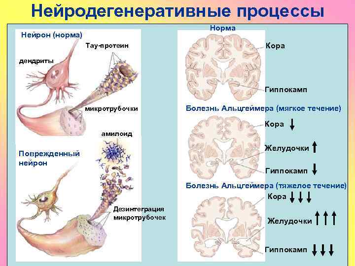 Нейродегенеративные процессы Норма Нейрон (норма) Тау-протеин Кора дендриты Гиппокамп микротрубочки Болезнь Альцгеймера (мягкое течение)