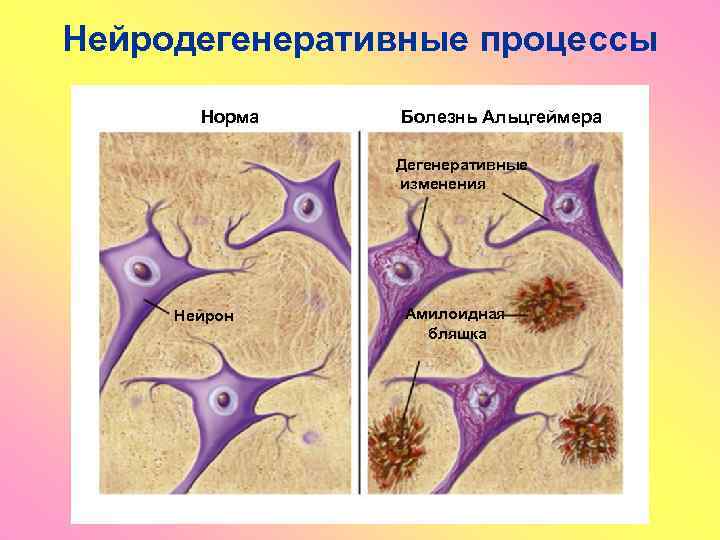 Нейродегенеративные процессы Норма Болезнь Альцгеймера Дегенеративные изменения Нейрон Амилоидная бляшка 