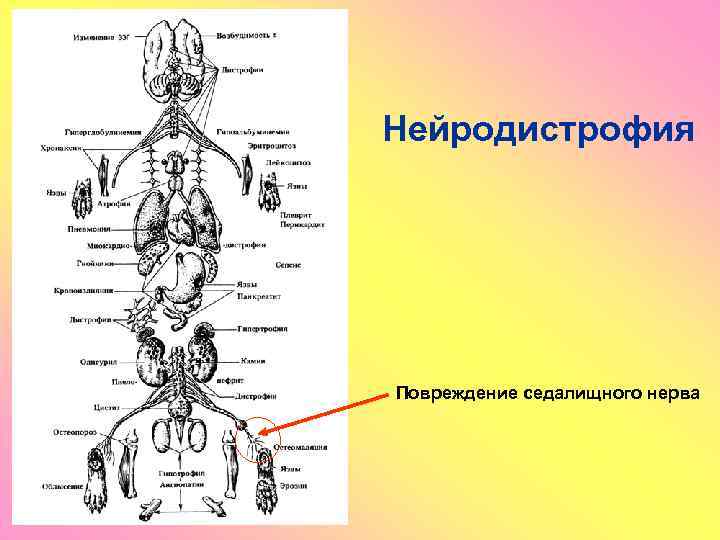 Нейродистрофия Повреждение седалищного нерва 