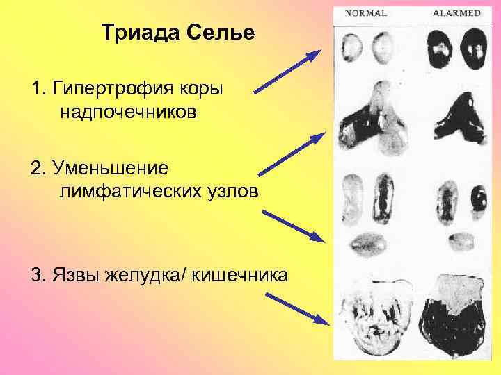 Триада Селье 1. Гипертрофия коры надпочечников 2. Уменьшение лимфатических узлов 3. Язвы желудка/ кишечника