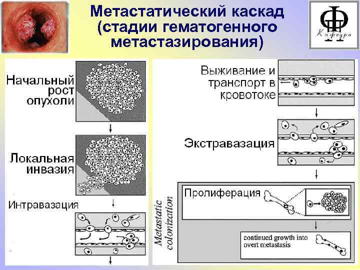 Метастатический каскад (стадии гематогенного метастазирования) 