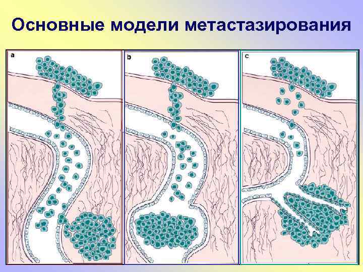 Основные модели метастазирования 