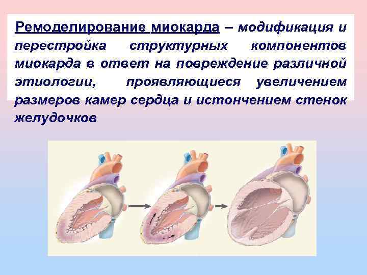 Ремоделирование миокарда – модификация и перестройка структурных компонентов миокарда в ответ на повреждение различной