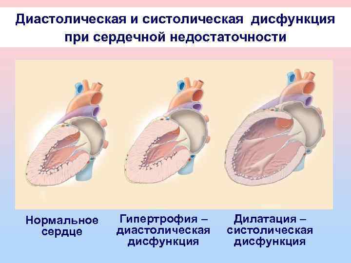 Диастолическая и систолическая дисфункция при сердечной недостаточности Нормальное сердце Гипертрофия – диастолическая дисфункция Дилатация