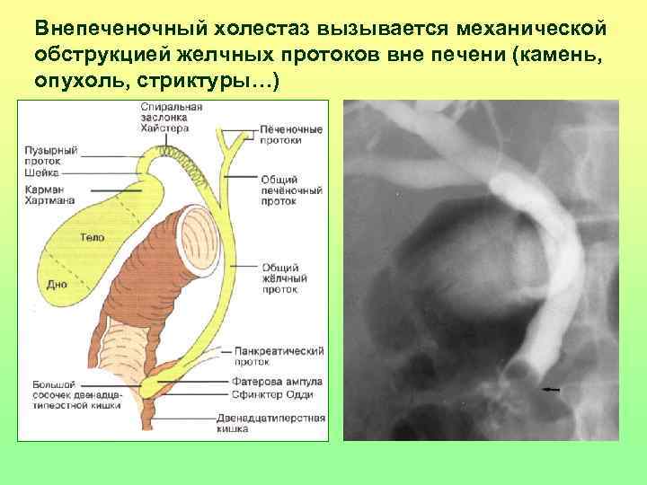 Внепеченочный холестаз вызывается механической обструкцией желчных протоков вне печени (камень, опухоль, стриктуры…) 