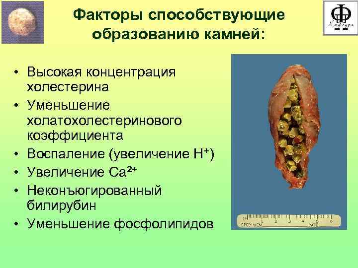 Факторы способствующие образованию камней: • Высокая концентрация холестерина • Уменьшение холатохолестеринового коэффициента • Воспаление