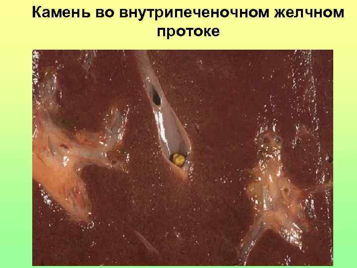 Камень во внутрипеченочном желчном протоке 