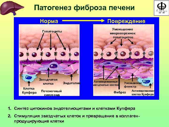 Патогенез фиброза печени Норма Повреждение Уменьшение микроворсинок гепатоцитов Гепатоциты Звездчатая клетка Купфера Печеночный синусоид