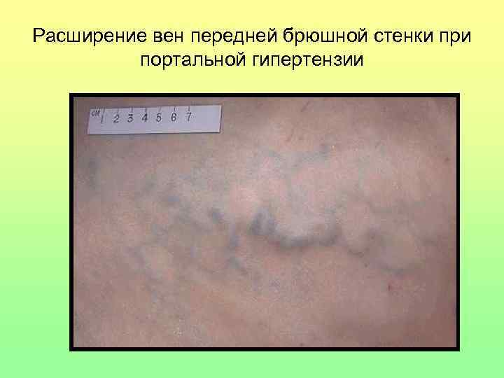 Расширение вен передней брюшной стенки при портальной гипертензии 
