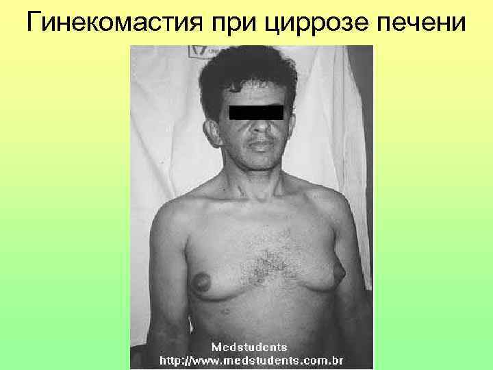 Гинекомастия при циррозе печени 