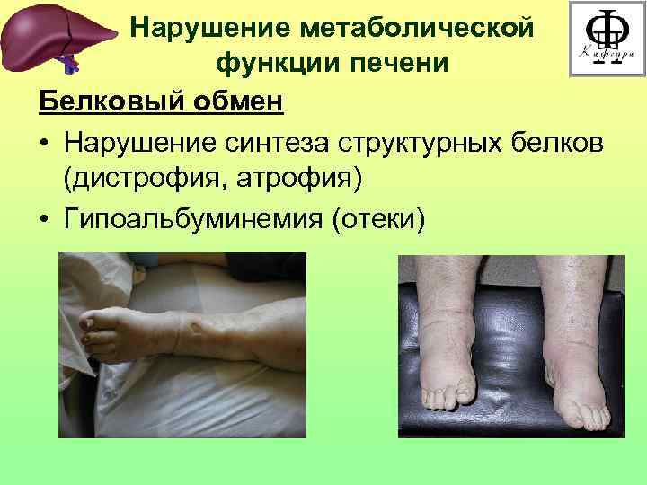 Нарушение метаболической функции печени Белковый обмен • Нарушение синтеза структурных белков (дистрофия, атрофия) •