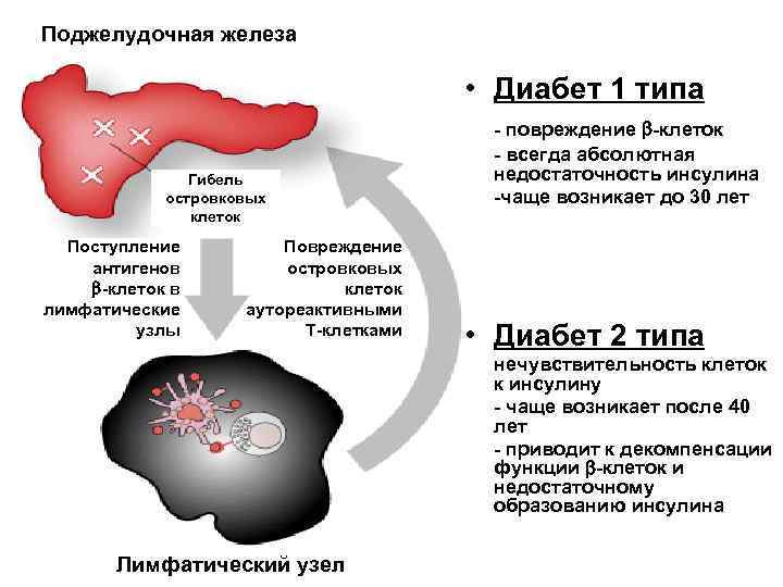 Сахарный диабет железа. Поджелудочная железа диабет. Патофизиология поджелудочной железы. Панкреатический диабет.