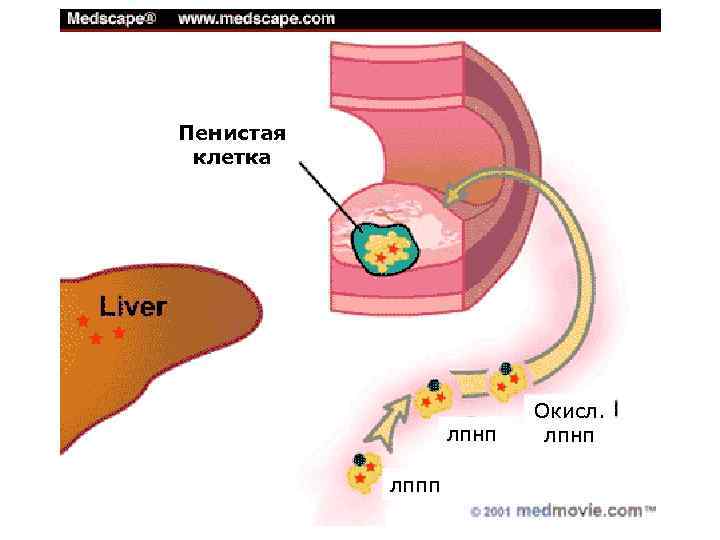 Пенистое содержимое. Пенистые клетки при атеросклерозе. Пенистые клетки. Образование пенистых клеток при атеросклерозе. Стадии атеросклероза пенистые клетки.