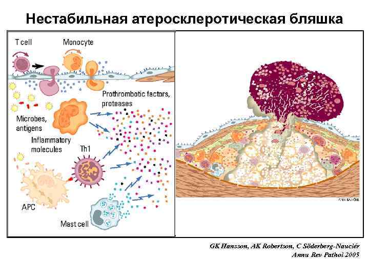 Нестабильная атеросклеротическая бляшка GK Hansson, AK Robertson, C Söderberg-Nauclér Annu Rev Pathol 2005 